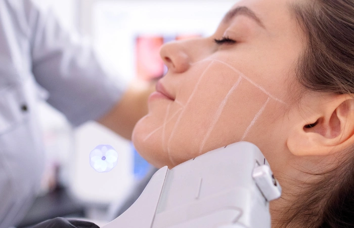 hifu facial